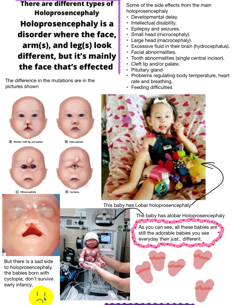 Holoprosencephaly In Humans