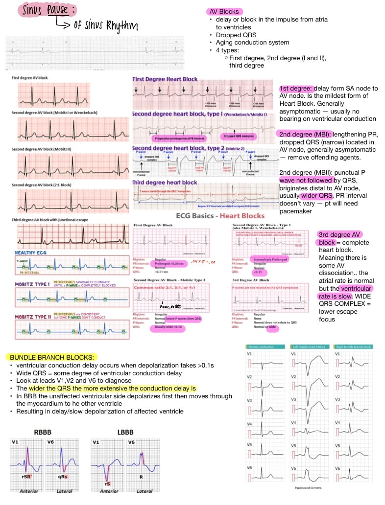 Heart Blocks And Arrhythmias - Notability Gallery